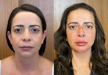 Antes e depois de harmonização facial