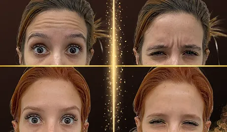 Antes e depois de toxina botulínica para rugas de expressão