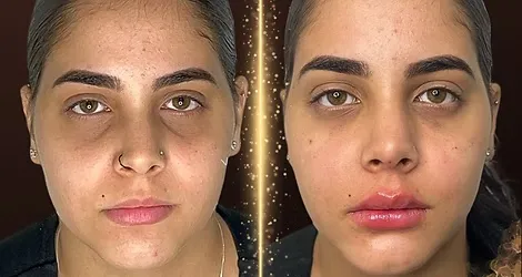 Antes e depois de tratamento de olheiras