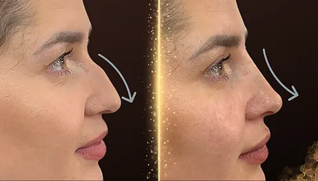 Antes e depois de perfiloplastia
