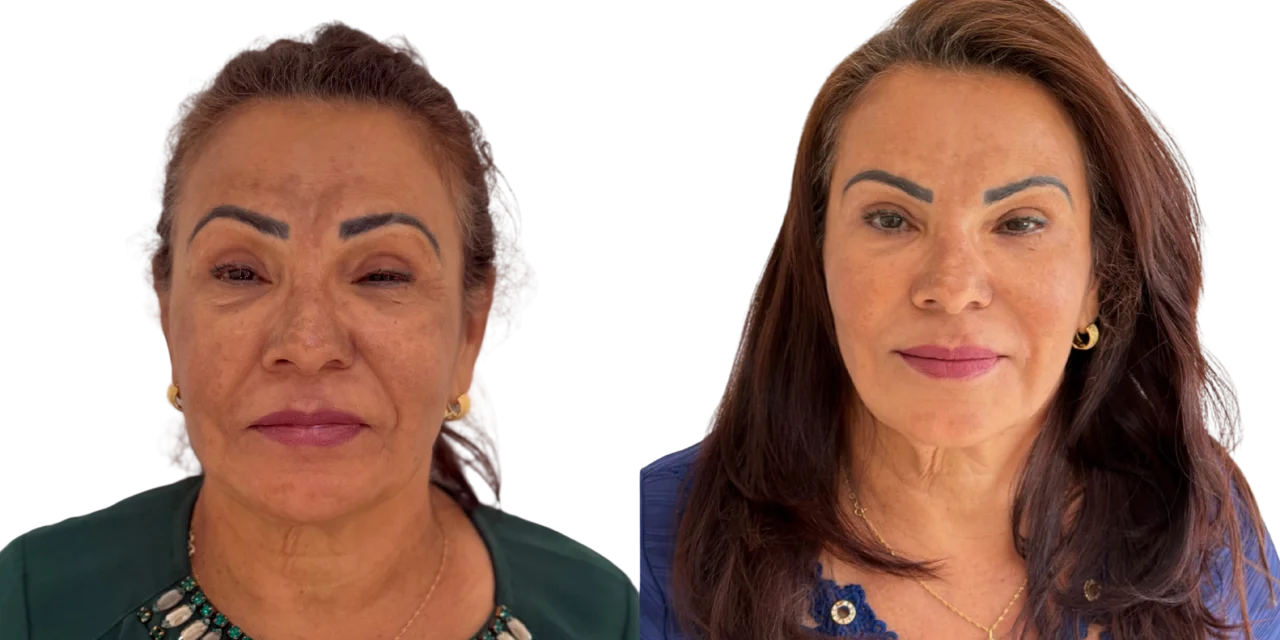 Botox Full Face: imagem ilustrativa do procedimento